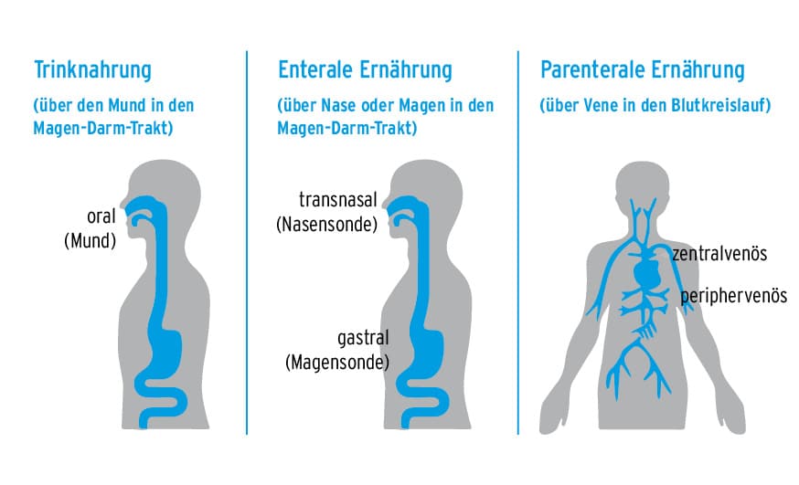 Trinknahrung vs enterale vs parenterale Ernährung